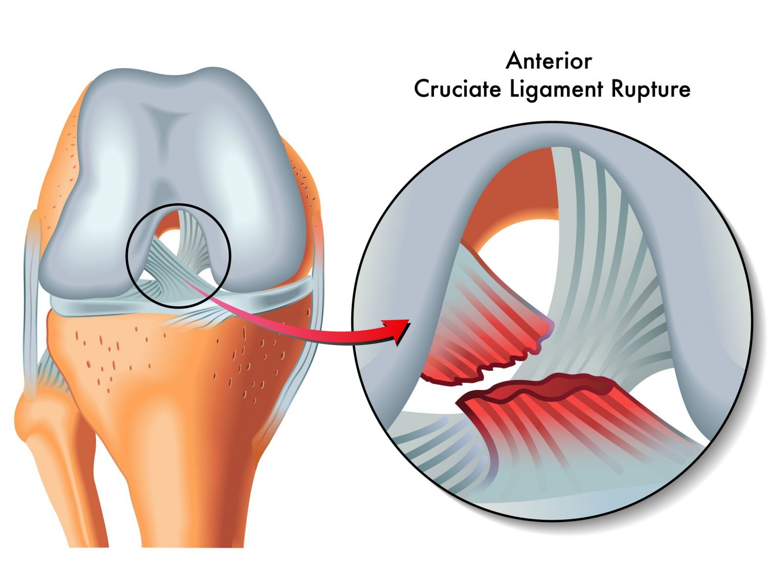 Knee Ligament Injuries Singapore Tears in ACL, MCL & PCL